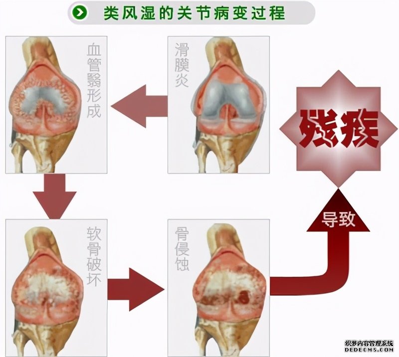 這些病癥你中了幾項？超過4項患類風濕性關節(jié)炎的幾率極高