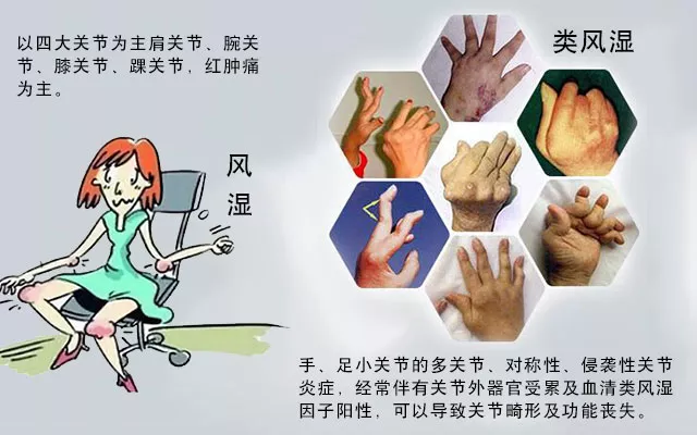 這些病癥你中了幾項？超過4項患類風濕性關節(jié)炎的幾率極高