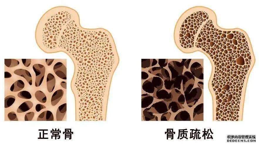 世界骨質(zhì)疏松日 | 預(yù)防“骨質(zhì)疏松”補(bǔ)鈣就可以了嗎？營養(yǎng)專家送你一份“護(hù)骨秘籍”