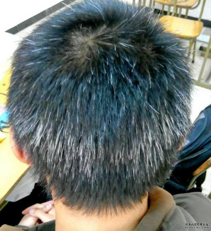 白發(fā)越長(zhǎng)越多，并非變老的信號(hào)，可能是身體缺乏這3種元素了